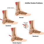 ankle-tendon-injury400 - Casteel Foot & Ankle Center