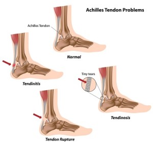 pain in heel and ankle