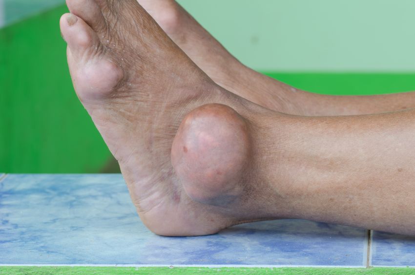 Gout Treatment Casteel Foot Ankle Center