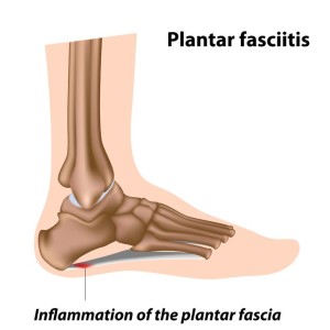 plantar fasciitis treatment shoes